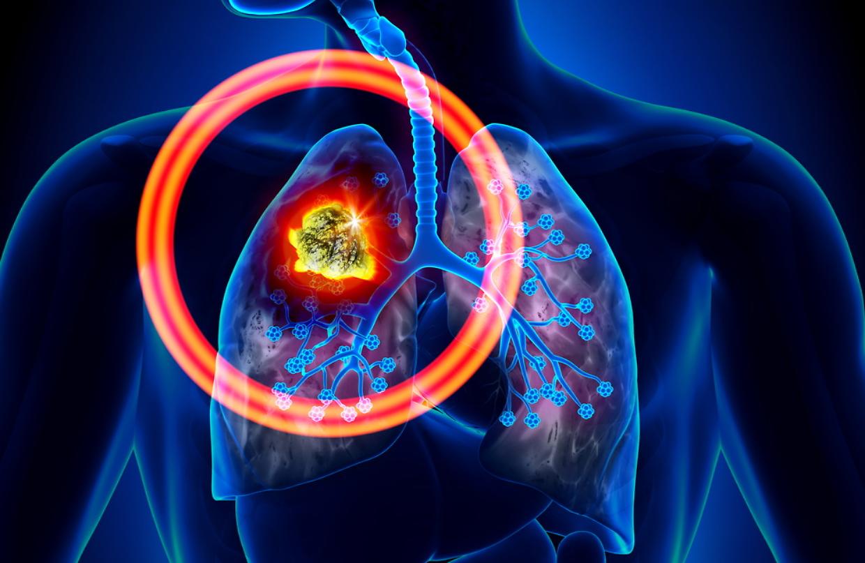 cancro al polmone