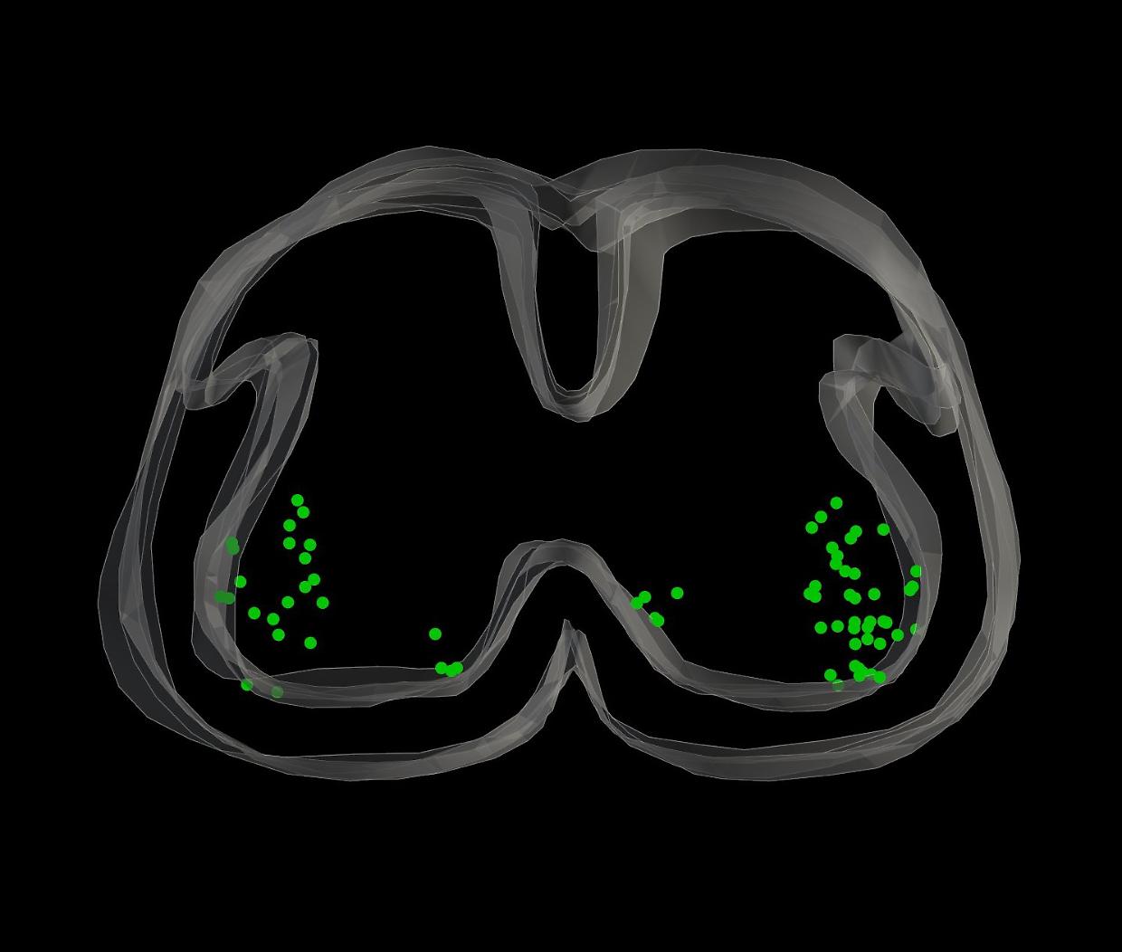 03 MR-409, migliorando l’innervazione ed il trofismo muscolare, ha anche contribuito a rallentare la degenerazione dei motoneuroni spinali (mostrati in verde)