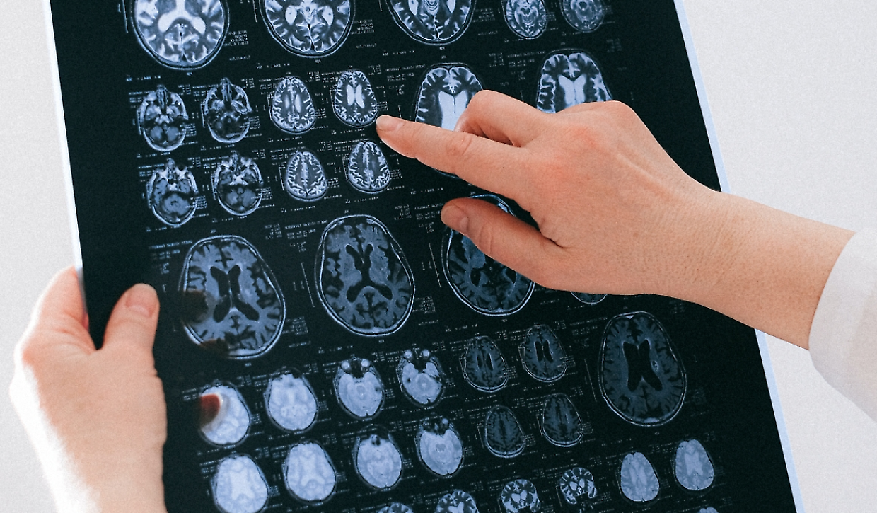 Tumore al cervello, scoperta una cura dai ricercatori delle Molinette di Torino