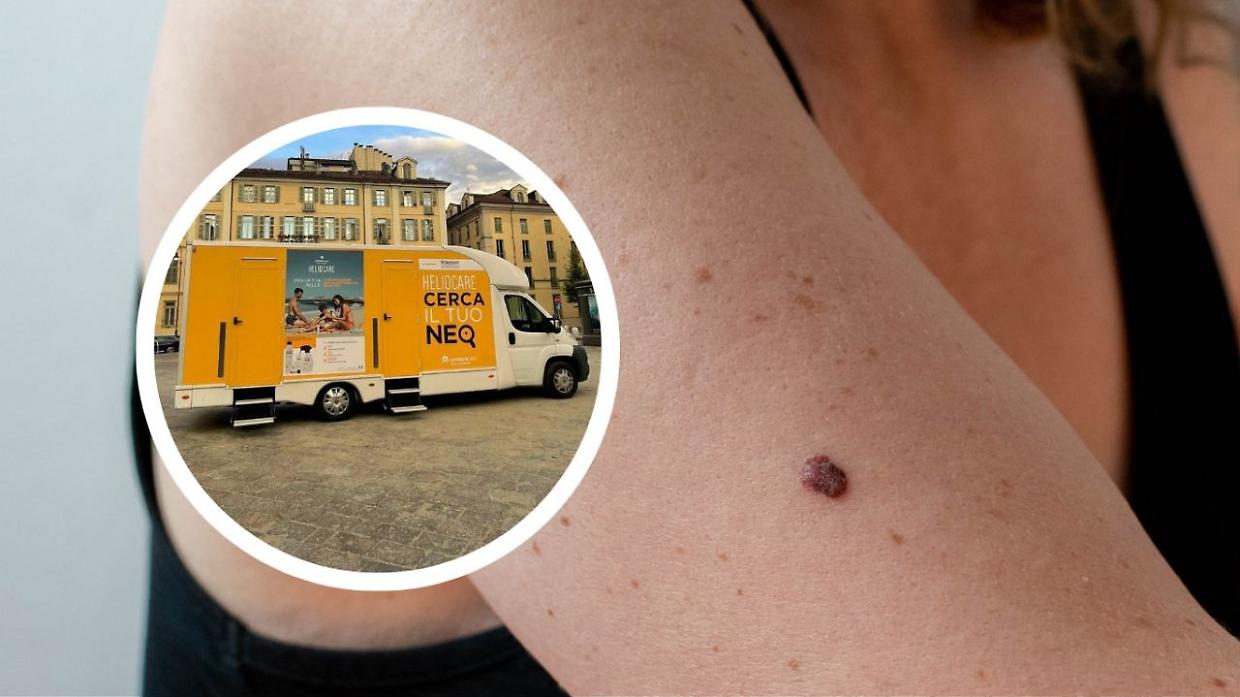 Un giorno per la salute della pelle: "Cerca il tuo neo" sbarca a Torino con screening gratuiti e lezioni di approfondimento