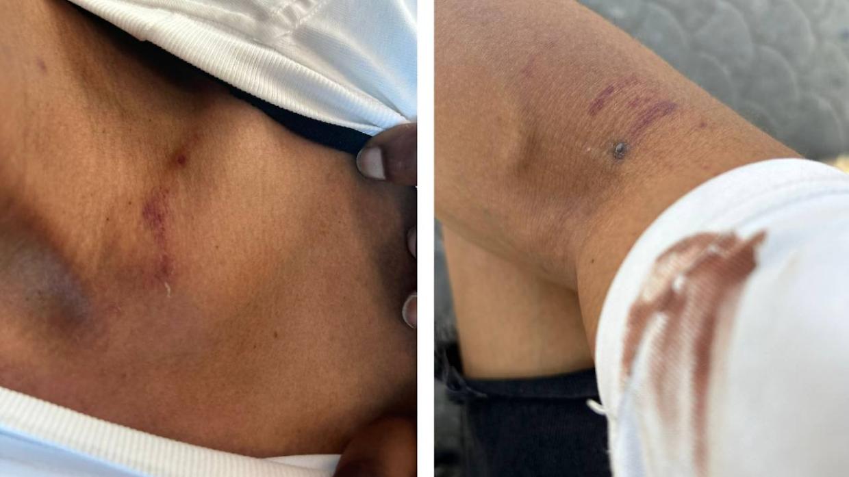 Le lesioni subite dal ragazzo di 25 anni, picchiato dal datore di lavoro