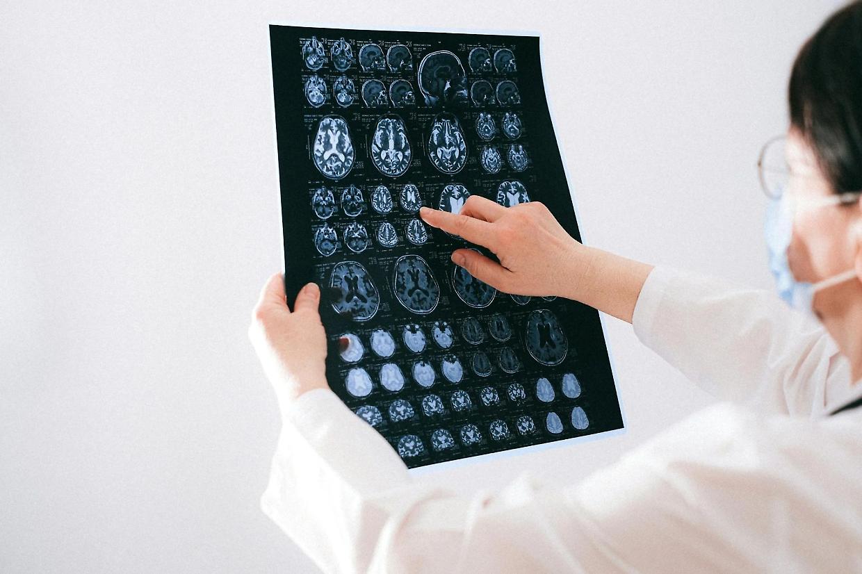 Scoperta rivoluzionaria a Torino: nuovo meccanismo per combattere le metastasi cerebrali 