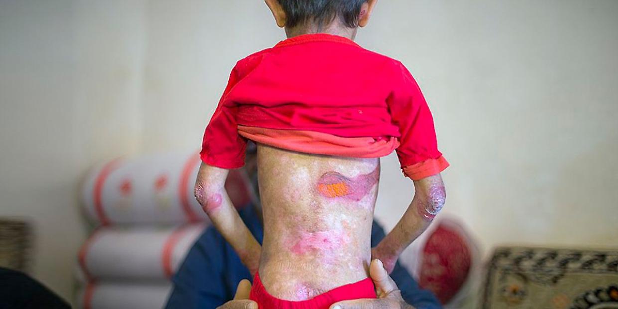 Sanità, è tutta italiana la nuova terapia  per la 'malattia dei bambini farfalla'