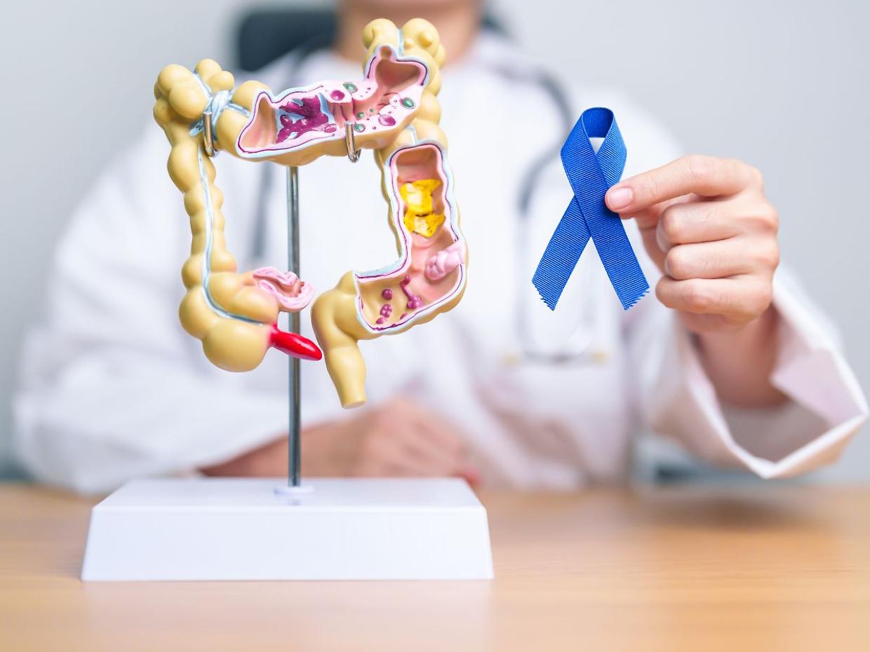 Tumore al colon in aumento tra i giovani: +500% tra gli adolescenti. Ecco i segnali da non ignorare