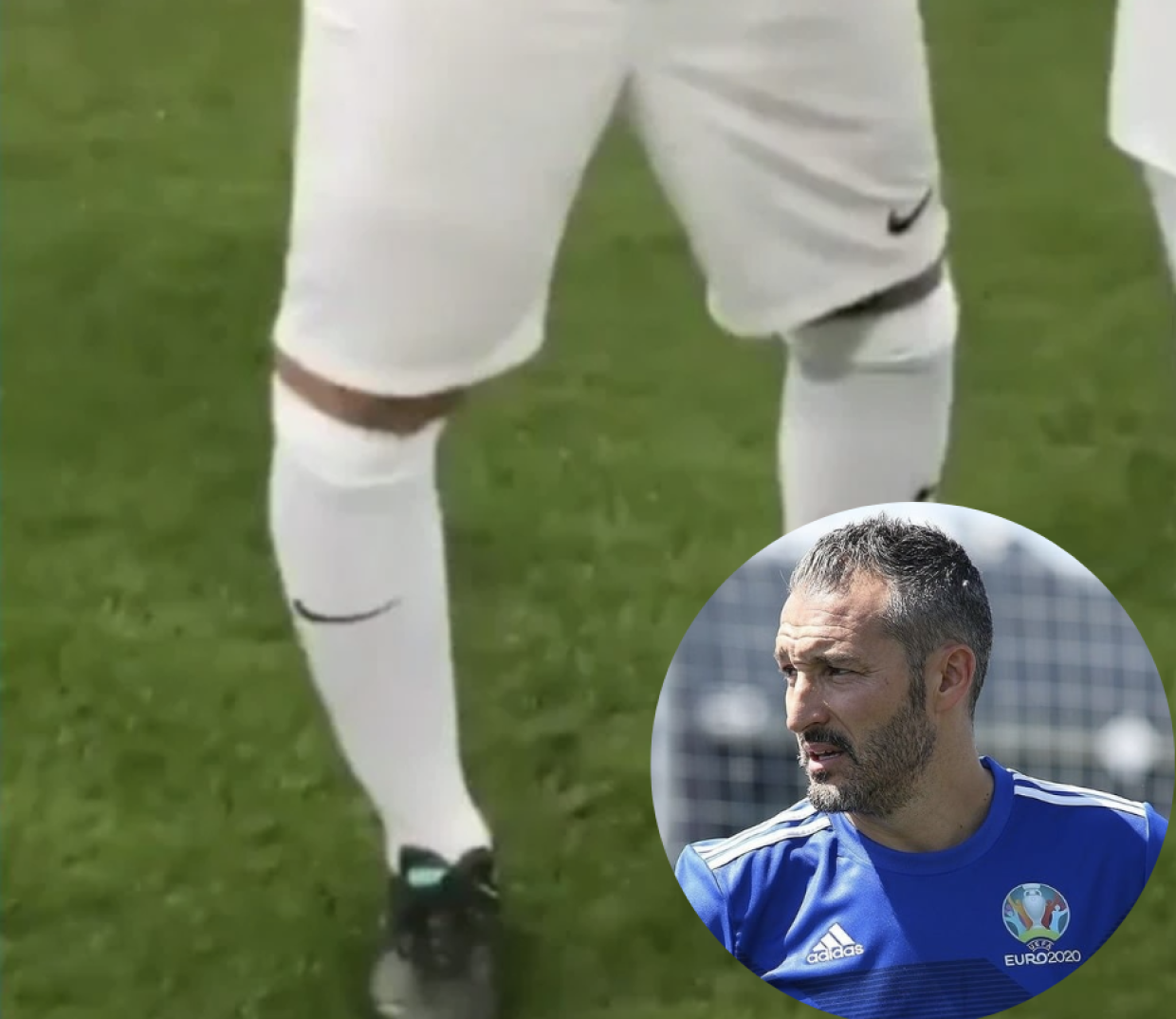 Zambrotta e il varismo: la sindrome (dolorosa) che in pochi conoscono