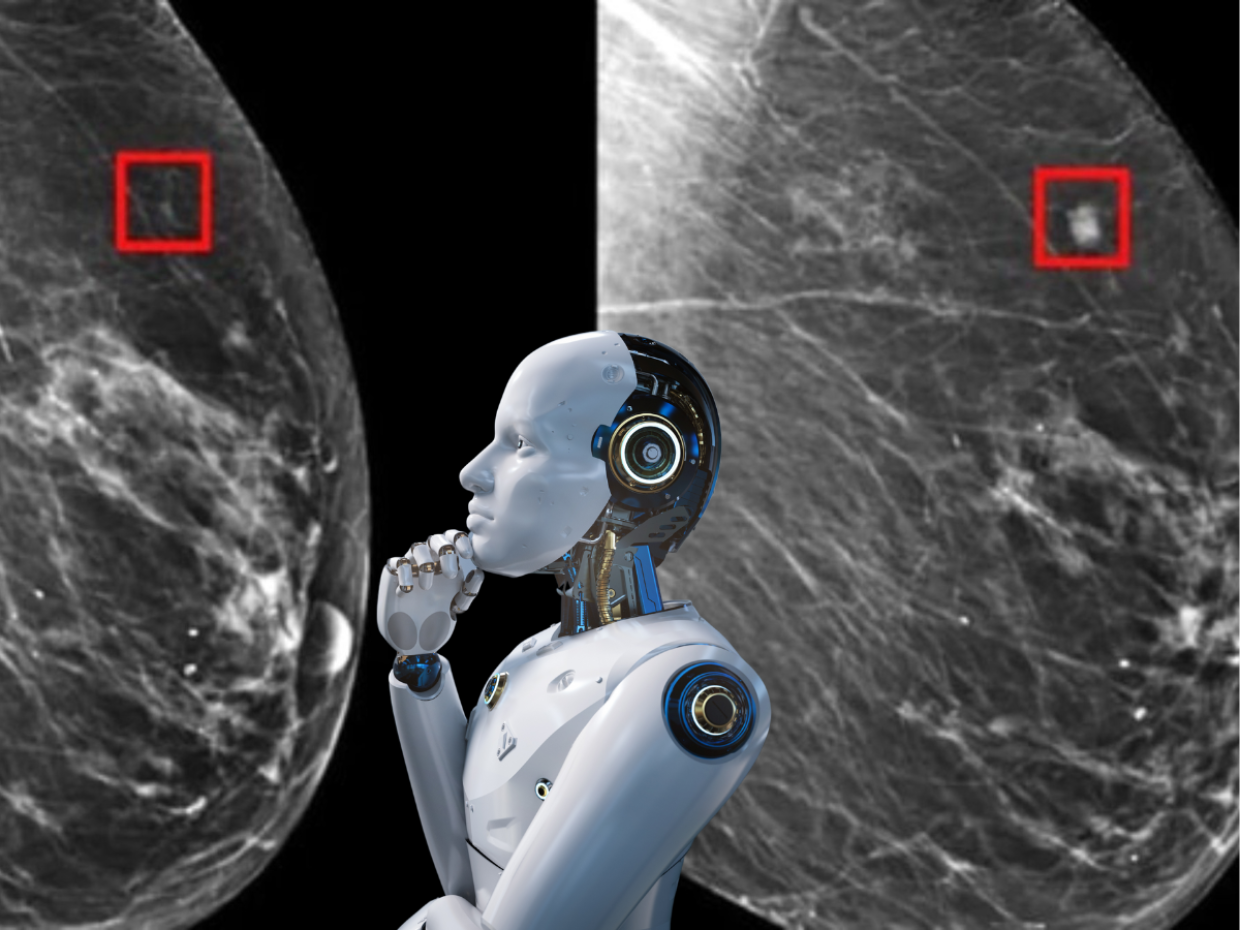Cancro al seno, svolta epocale: l’Intelligenza Artificiale lo prevede fino a 4 anni prima