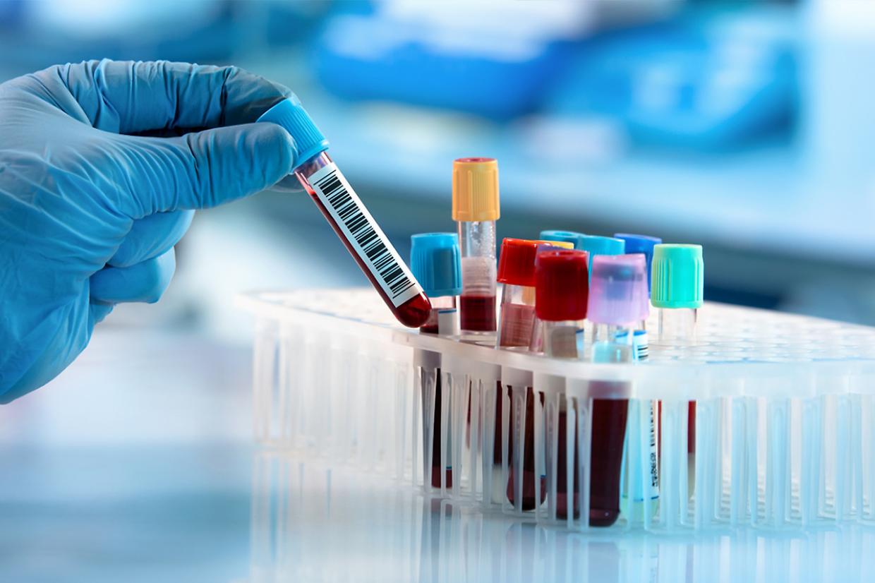 Un solo esame del sangue per scovare 12 tumori prima dei sintomi: la rivoluzione di miONCO-Dx