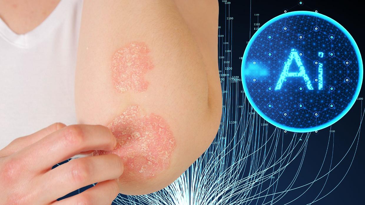 Dermatite atopica sotto controllo: l’intelligenza artificiale ora diagnostica l’eczema