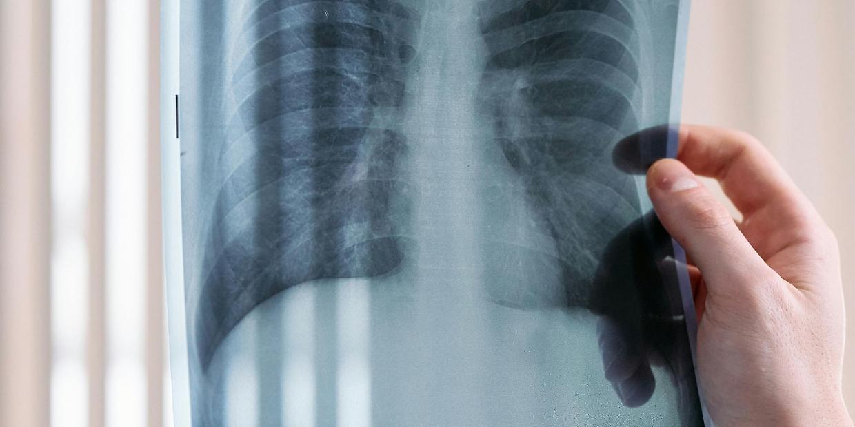Tumore al polmone, svolta nella cura dell’ALK-positivo: approvata in Italia la prima terapia mirata adiuvante