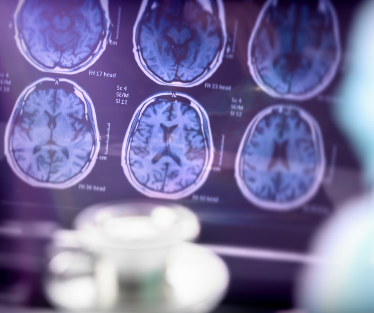 Alzheimer, la diagnosi fa un balzo nel futuro: primo test del sangue approvato, l’Italia protagonista