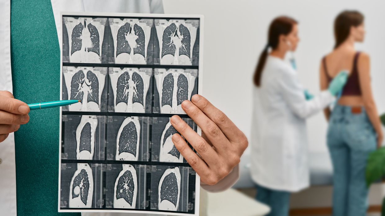 Nuovo approccio contro il carcinoma polmonare avanzato:  il 75% dei pazienti operabili