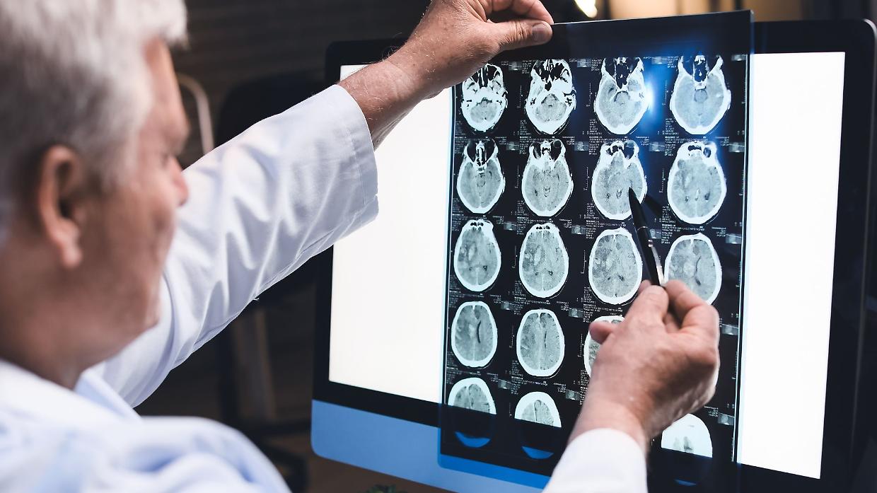 Alzheimer: fino a 4 anni per la diagnosi: : “Metà dei casi non viene riconosciuta”