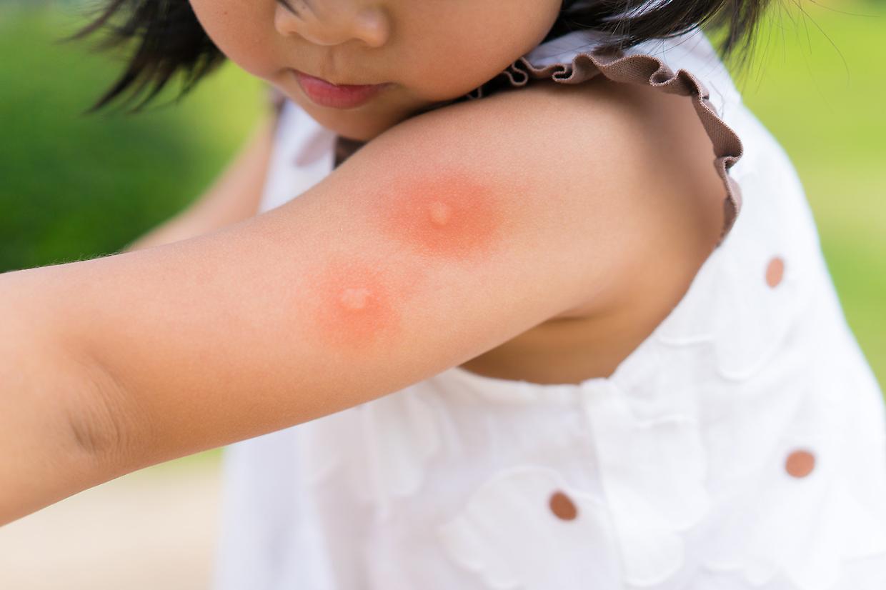 Punture d’insetto in vacanza: come riconoscerle e proteggersi