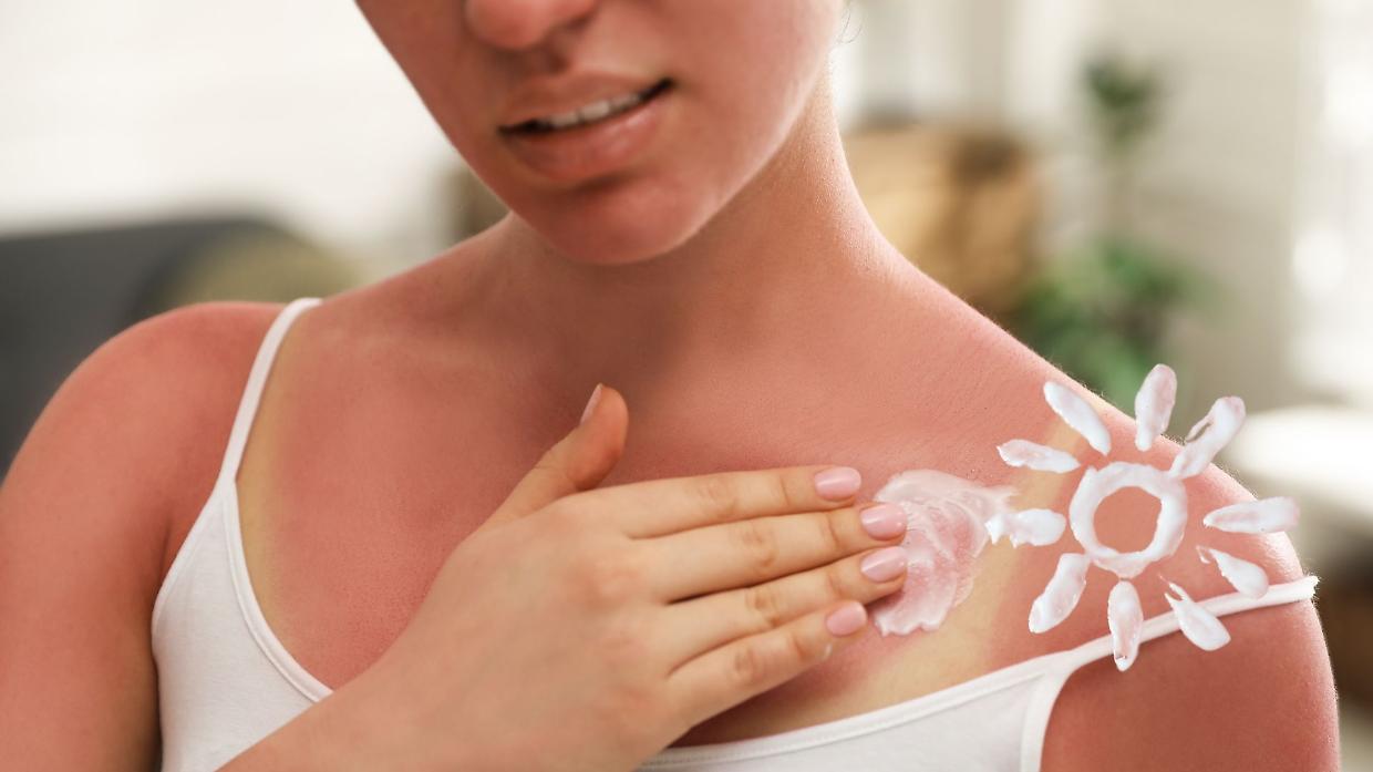 Eritema solare: come riconoscerlo subito e i rimedi naturali che funzionano davvero
