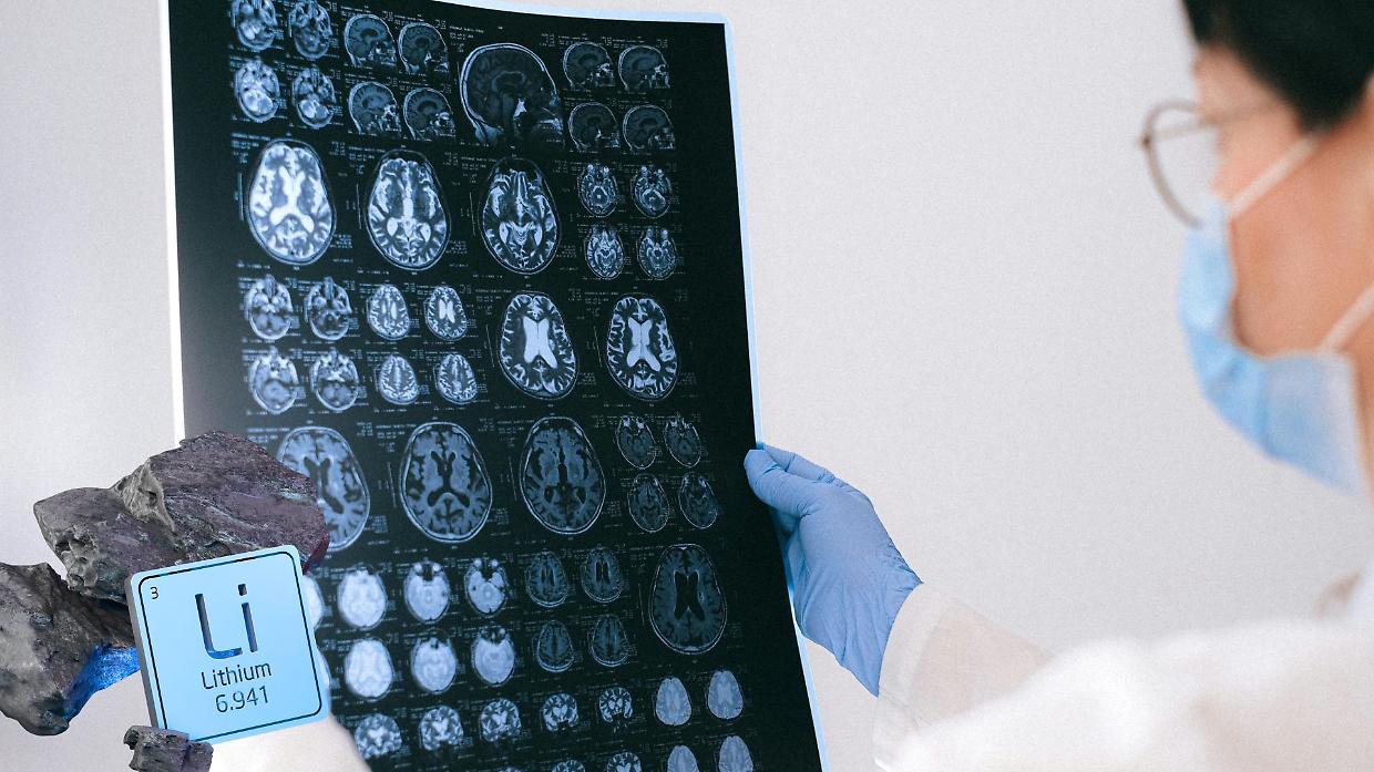 Alzheimer: il litio potrebbe fermare il declino cognitivo, una scoperta rivoluzionaria cambia tutto