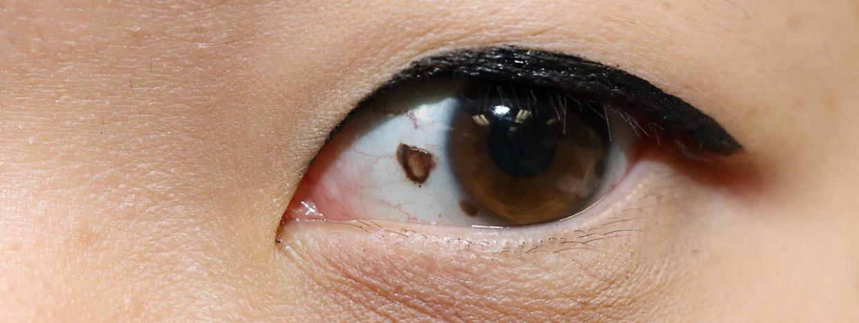 Melanoma oculare: riconoscerlo in tempo per proteggere la vista