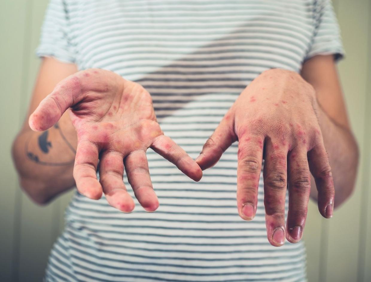 Morbillo, quasi 1 italiano su 10 è suscettibile al virus: i dati dello studio
