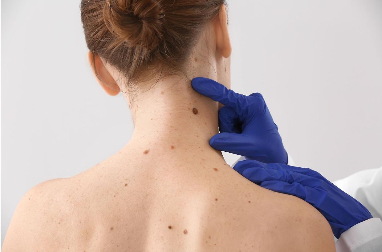 Melanoma, il 70% nasce da nei nuovi: lo studio che cambia la prevenzione