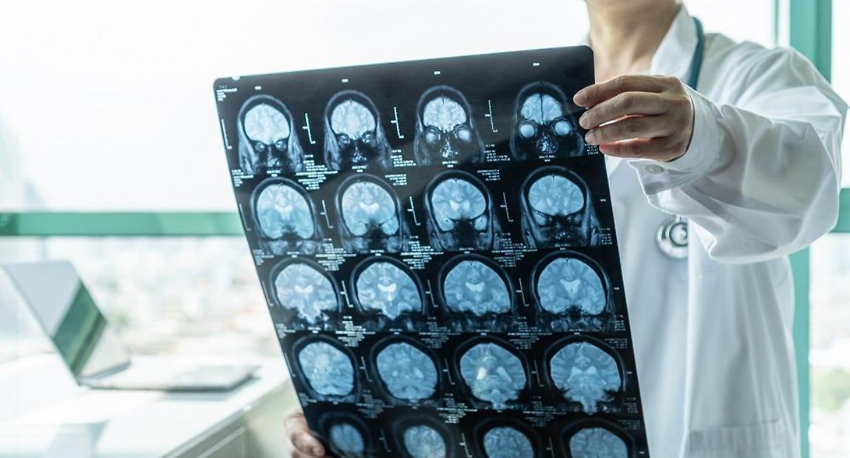 Alzheimer, visite rapide senza impegnativa: come fissare un appuntamento