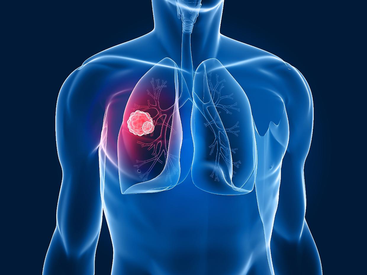 Tumore ai polmoni, svolta nelle cure: metà dei pazienti vive oltre quattro anni