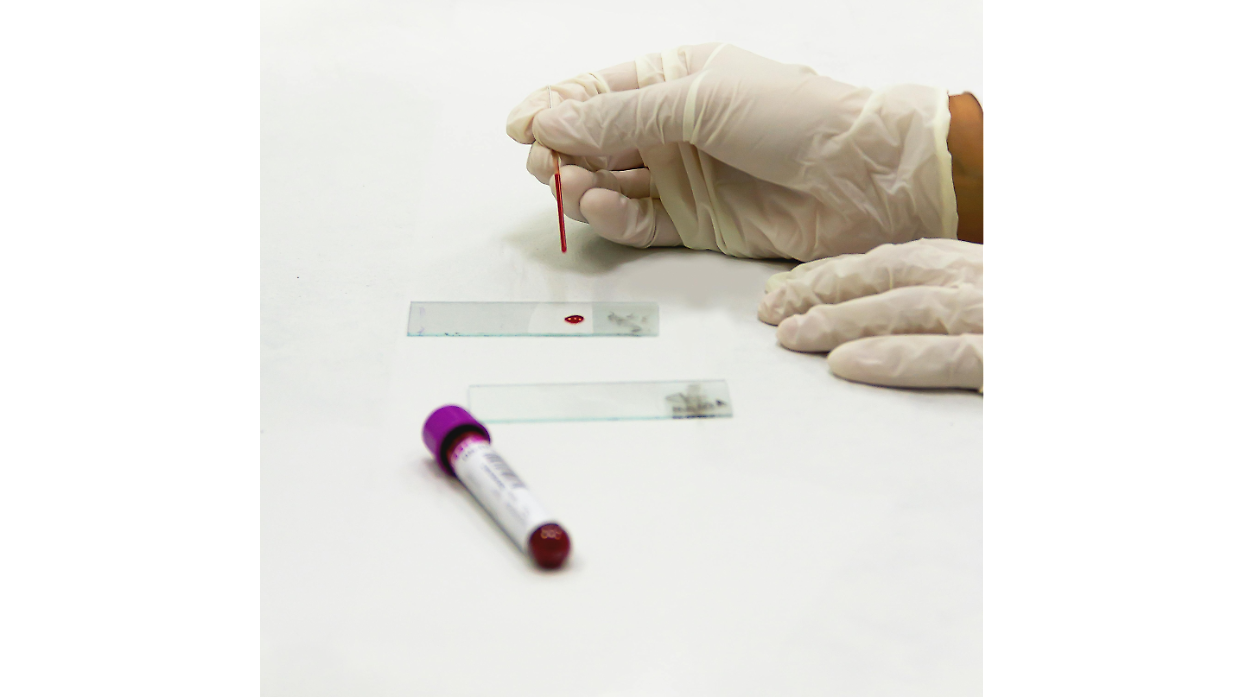 Sifilide, l'allarme degli esperti per l'aumento dei casi in Italia: si registra un +20%