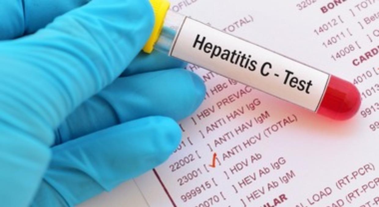 L'Epatite A arriva anche a Latina, 24 casi accertati: scattano controlli e task force