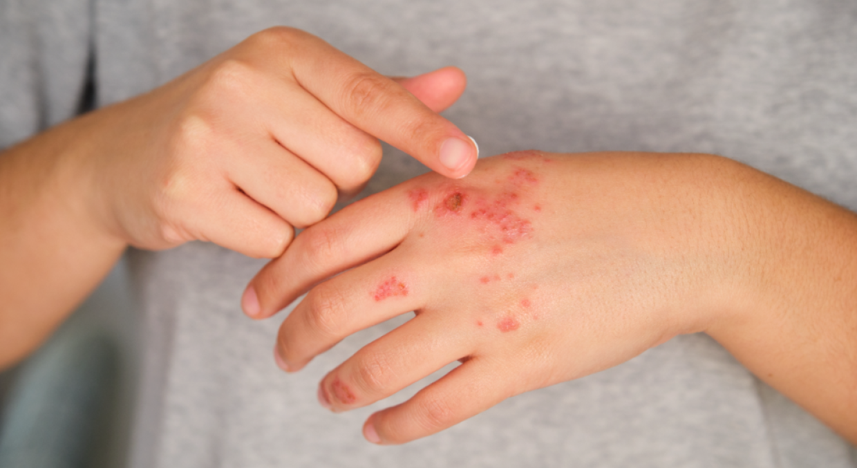 Psoriasi, oltre 1,5 milioni di italiani colpiti: impatto forte su vita sociale e lavoro