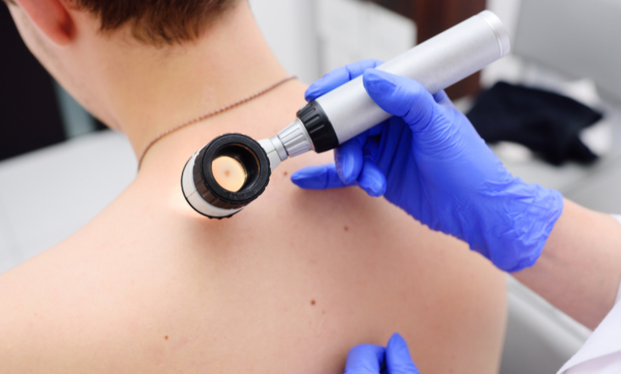 Melanoma in Piemonte, scatta l'allarme: casi in aumento e liste d'attesa bloccate
