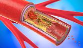 Evolocumab e stenosi carotidea