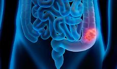 Marzo mese della prevenzione, l'appello per lo screening del tumore al colon-retto