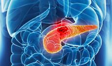 Tumore del pancreas, svolta dalla ricerca: un nuovo farmaco raddoppia la sopravvivenza