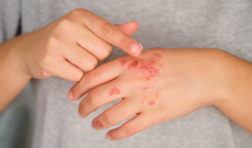 Psoriasi, oltre 1,5 milioni di italiani colpiti: impatto forte su vita sociale e lavoro