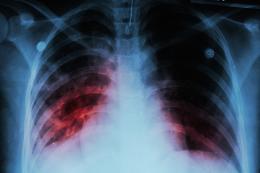 Torna l'incubo tubercolosi: 265 contagi in un anno