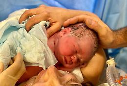 Al Martini il "taglio cesareo gentile" per favorire il primo contatto tra il neonato e la madre