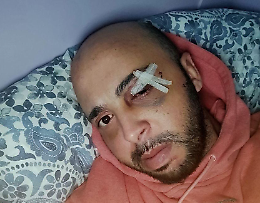 Picchiano un invalido col tirapugni: «Mi hanno anche rubato la bici»