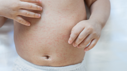 Esplosione delle allergie alimentari nei bambini: i dati e le cause del fenomeno in Italia