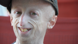Sammy Basso: malore al ristorante, muore a 28 anni il malato di progeria più longevo al mondo