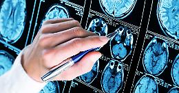 Epilessia, 50mila vittime in Piemonte - Il 60% dei pazienti non trova lavoro
 