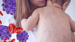 Morbillo, numeri mai visti in Europa: oltre 127 mila casi nel 2024, il dato più alto in 25 anni
