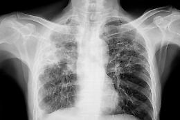 La tubercolosi torna a crescere in Europa: aumento preoccupante tra i minori
