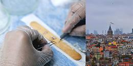 La soluzione per le calvizie, Istanbul capitale mondiale del trapianto 