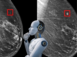 Cancro al seno, svolta epocale: l’Intelligenza Artificiale lo prevede fino a 4 anni prima