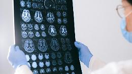Idrocefalo normoteso: "il falso alzheimer" che costa cari errori di diagnosi, in Italia 115mila casi nel 2024, quali sono i sintomi?