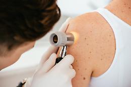 Melanoma Day: il 24 maggio la pelle al centro della prevenzione