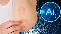 Dermatite atopica sotto controllo: l’AI ora diagnostica l’eczema