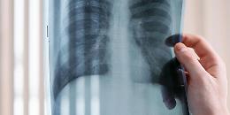 Tumore al polmone, svolta nella cura dell’ALK-positivo: approvata in Italia la prima terapia mirata adiuvante