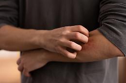 Allarme scabbia in aumento:  l’Italia tra i Paesi più colpiti in Europa