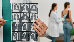Nuovo approccio contro il carcinoma polmonare avanzato:  il 75% dei pazienti operabili