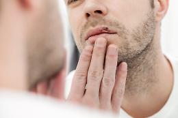 Hai mai avuto l’herpes labiale? Potrebbe nascondere un pericolo per il cervello