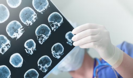 Lo zucchero: l’arma nascosta nella battaglia contro l’Alzheimer